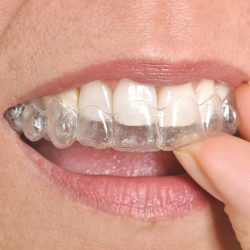 invisalign3.jpg